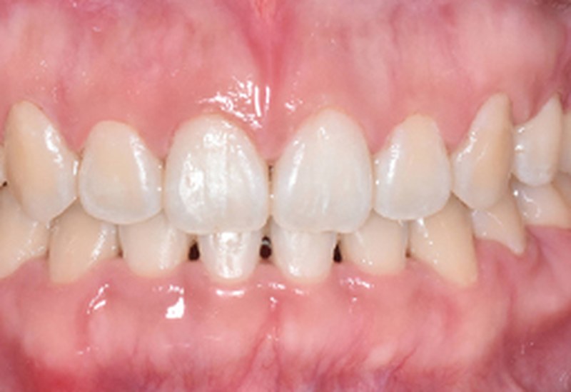 After — gum contouring