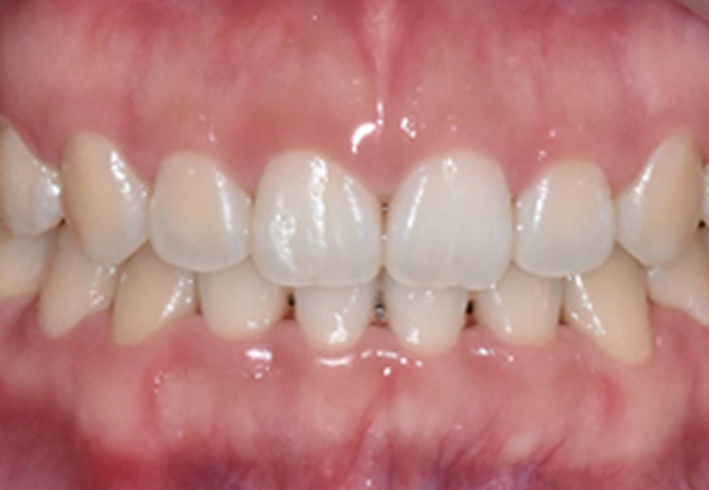 Before — gum contouring