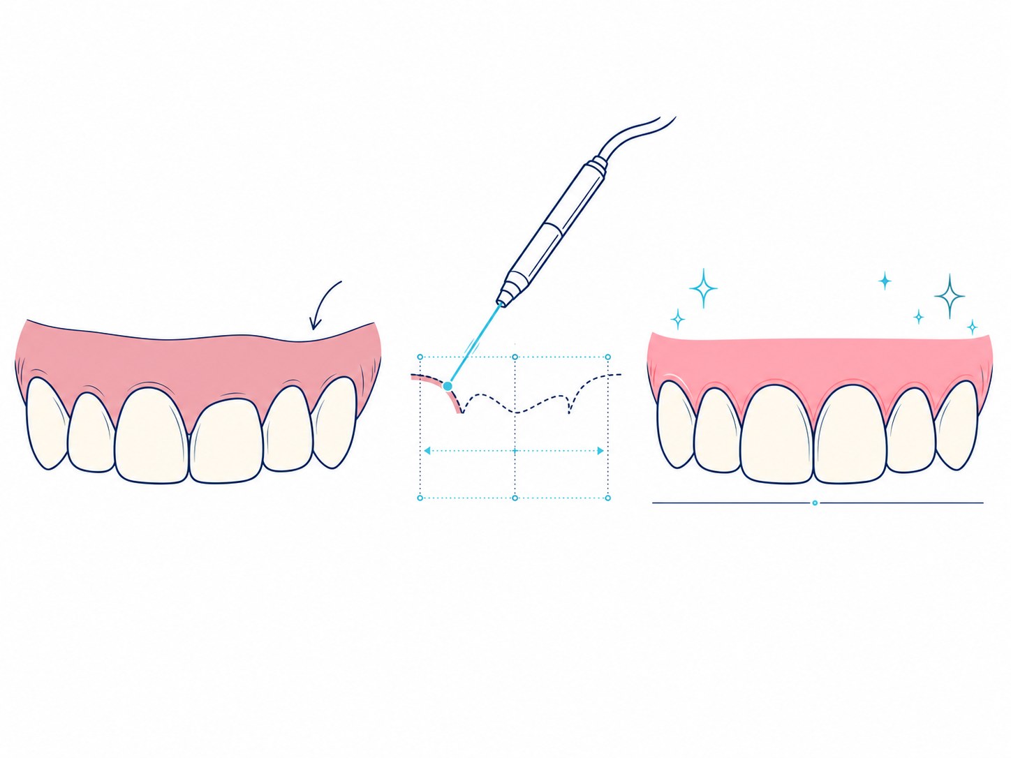 Gum contouring illustration