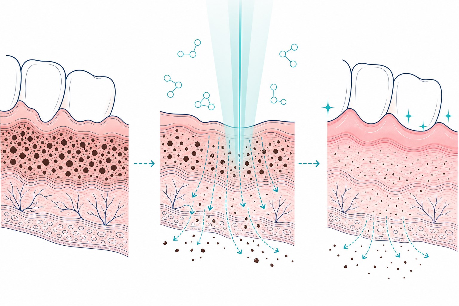 Gum whitening medical mechanism illustration