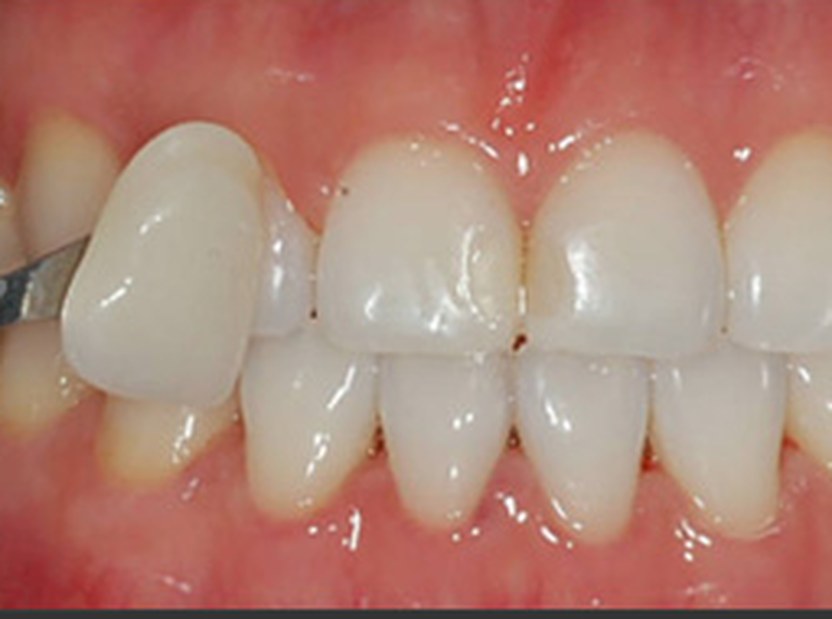 After whitening — brighter shade