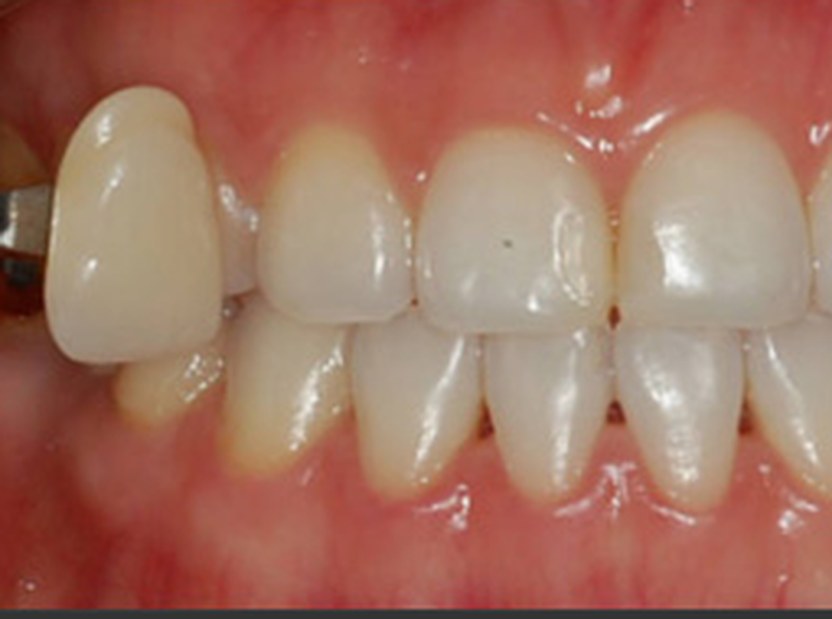 Before whitening — natural tooth shade