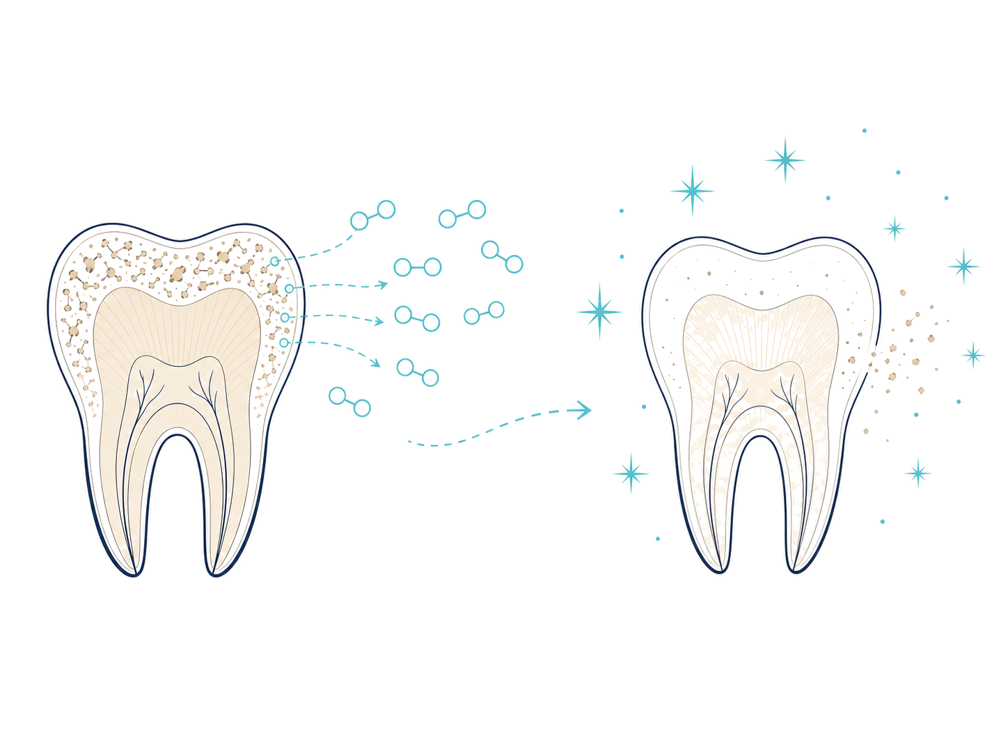 Illustration: restoring natural tooth shade