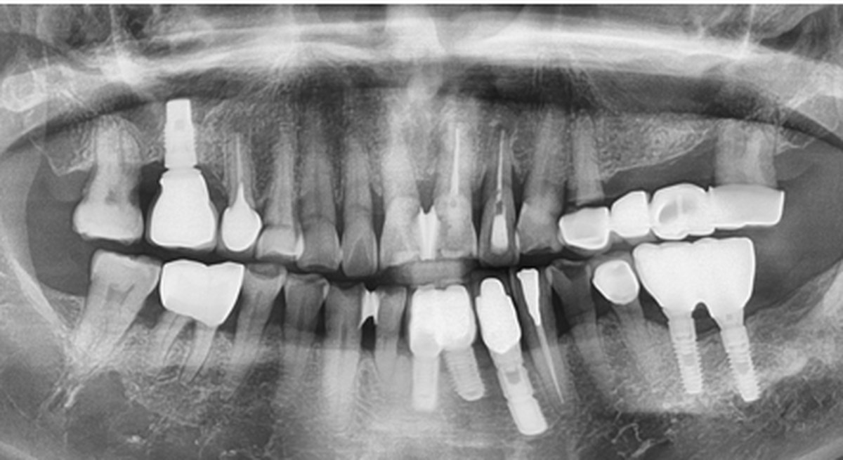Case 01 panoramic X-ray — After