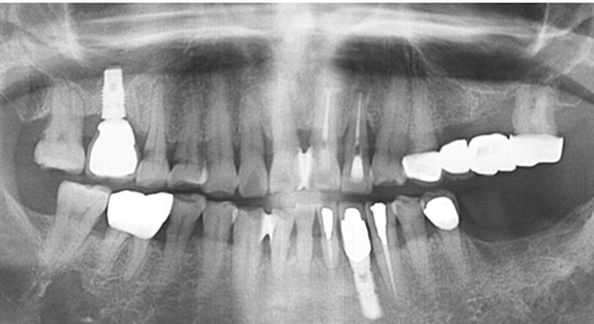 Case 01 panoramic X-ray — Before