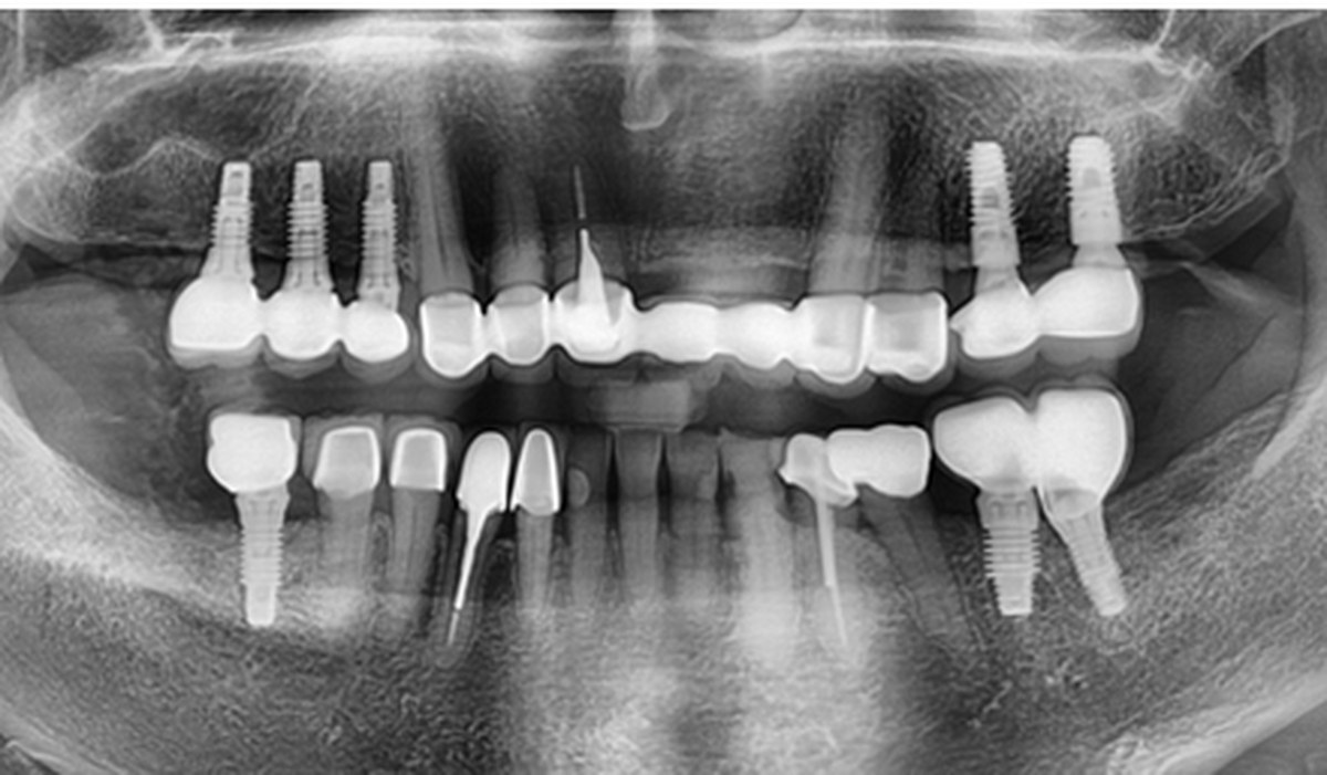 Case 02 panoramic X-ray — After