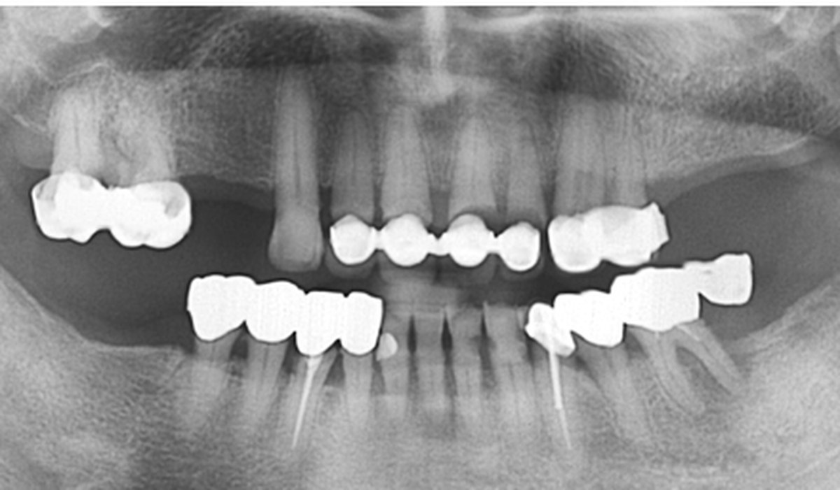 Case 02 panoramic X-ray — Before