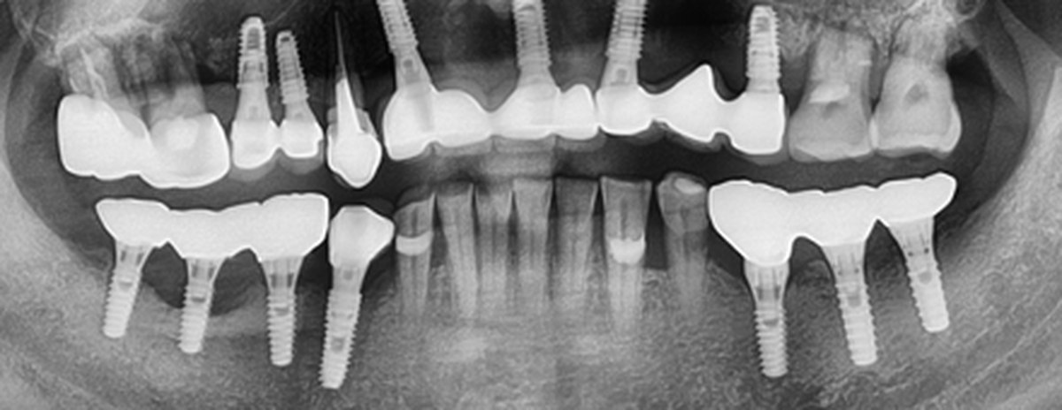 Case 03 panoramic X-ray — After
