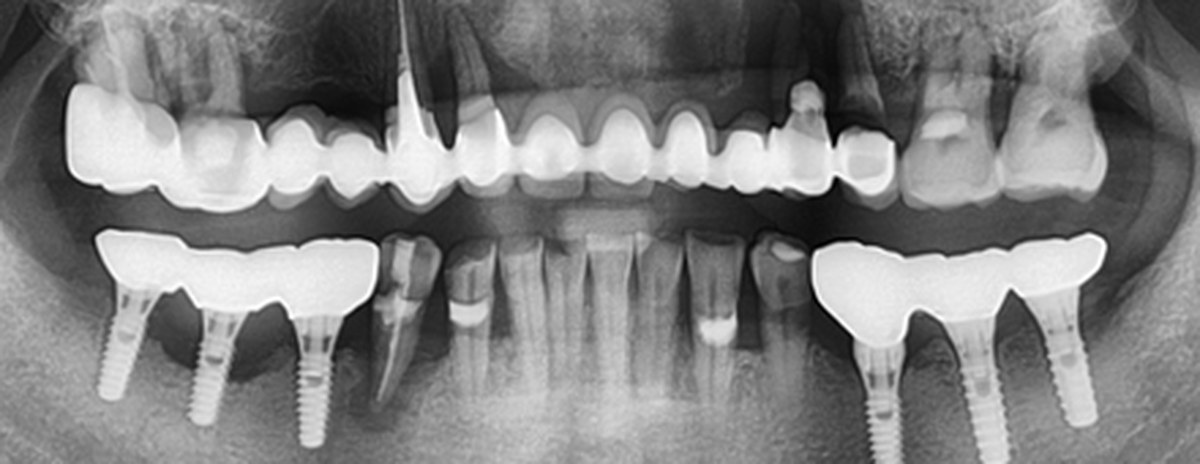 Case 03 panoramic X-ray — Before