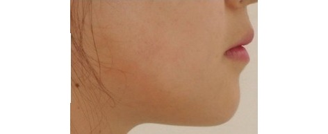 After · Face · Profile
