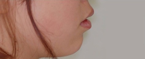 Before · Face · Profile