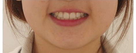 After · Face · Smile