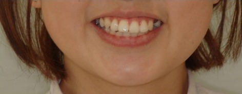 Before · Face · Smile