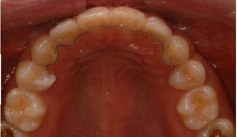 After · Intraoral · Upper