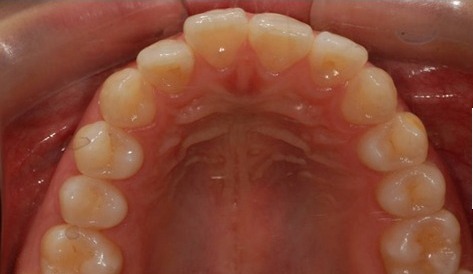 Before · Intraoral · Upper