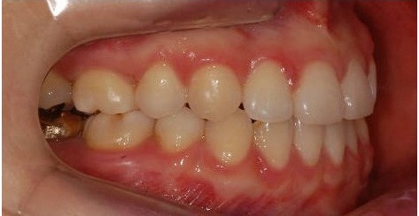 After · Intraoral · Side