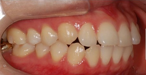 Before · Intraoral · Side