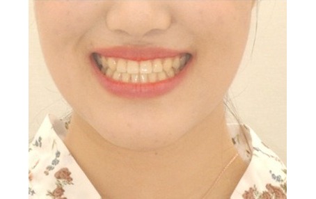 교정 후 · 정면 얼굴