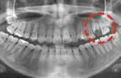 치료 전 — 파노라마 X-ray