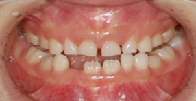 After — Intraoral