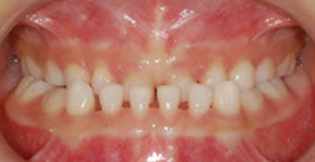 Before — Intraoral