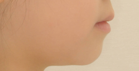 After — Lateral