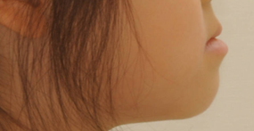 Before — Lateral