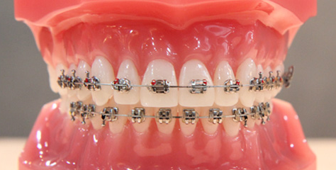 Metal bracket model — pink gum mockup