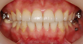 Lingual braces — frontal smile