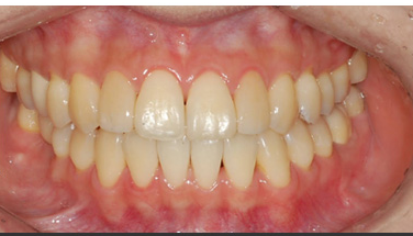 After treatment