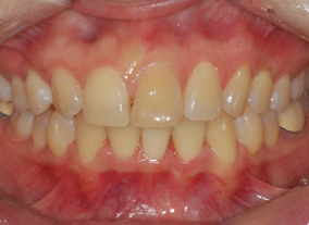 After — Frontal View