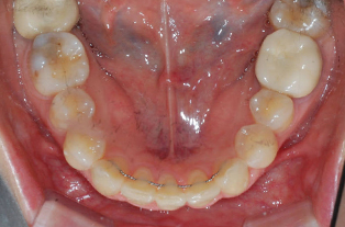 After — Upper Occlusal View