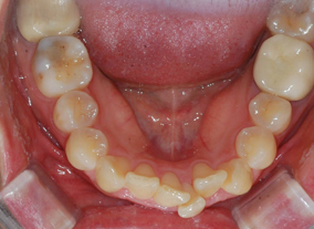Before — Upper Occlusal View