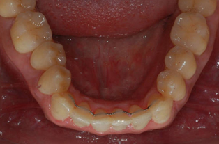 After — Upper Occlusal View