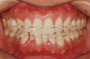 Before — Frontal View