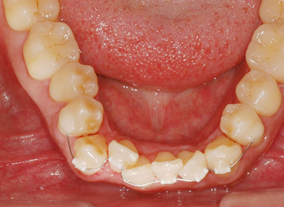 Before — Upper Occlusal View
