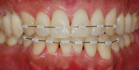 Partial orthodontic — front intraoral with brackets