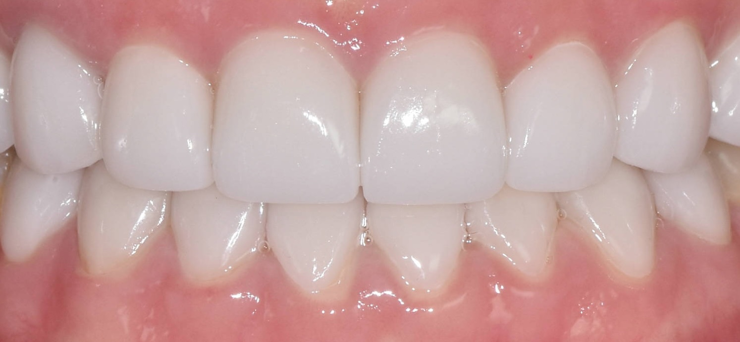After treatment