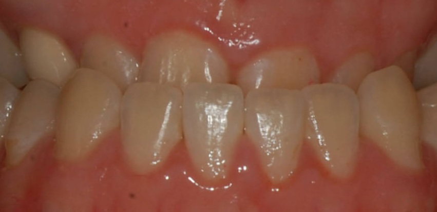 Before treatment