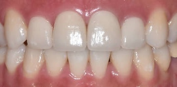 After treatment