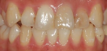 Before treatment
